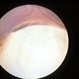 Iris nevus Iris nevus